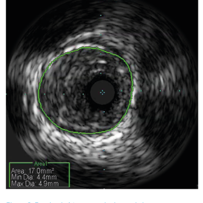 Figure 3. Proximal obtuse marginal vessel size