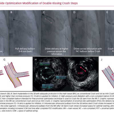 Proximal Side Optimization Modification of Double Kissing Crush Steps