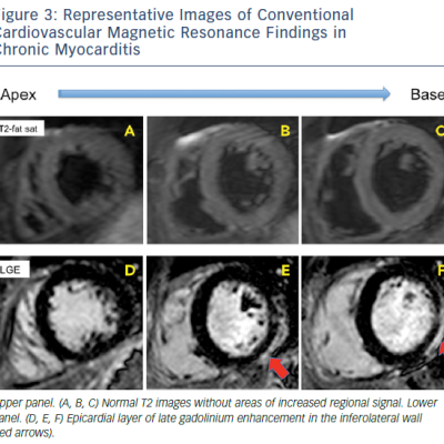 Figure 3 Representative Images Of Conventional Cardiovascular Magnetic Resonance Findings In Chronic Myocarditis