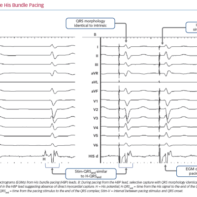 Selective His Bundle Pacing