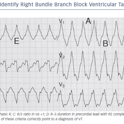 Figure 3 Several Criteria Correctly Identify Right Bundle Branch Block Ventricular Tachycardia