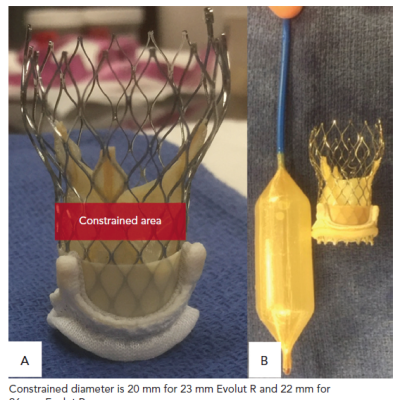 The Constrained Area of a Self-expanding Transcatheter Heart Valve