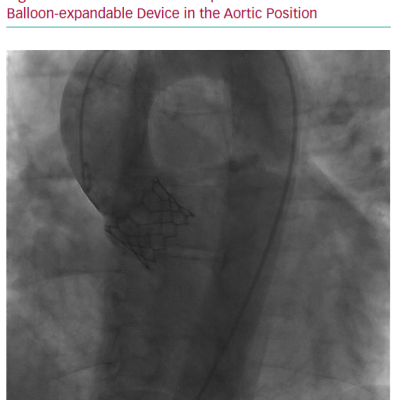 Transcatheter Valve Implantation of a Balloon-expandable Device in the Aortic Position