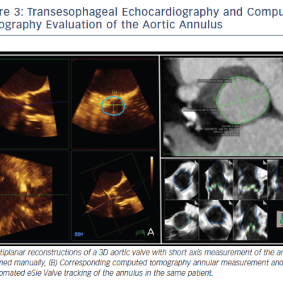 Figure 3 Transesophageal Echocardiography and Computed Tomography Evaluation of the Aortic Annulus