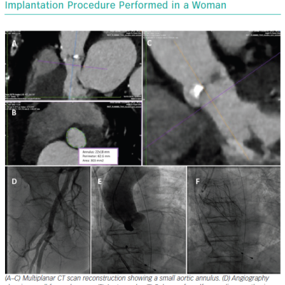 Transfemoral Transcatheter Aortic Valve Implantation Procedure Performed in a Woman