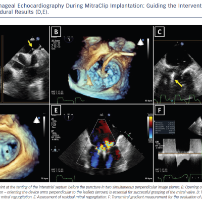 Figure 3 Transoesophageal Echocardiography During MitraClip Implantation Guiding the Intervention A–C and the Assessment of Procedural Results DE.