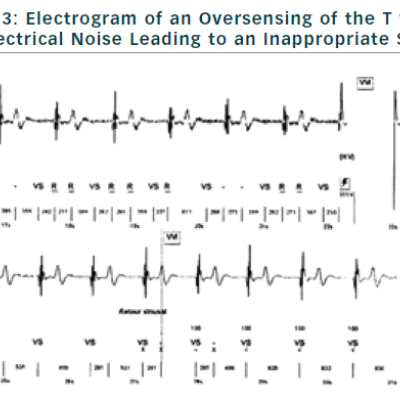 Figure 3 Electrogram of an Oversensing of the T wave and Electrical Noise Leading to an Inappropriate Shock