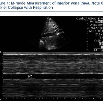 M-mode Measurement of Inferior Vena Cava