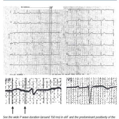 Figure 4 This is an Example of Partial Interatrial Block without Left Atrial Enlargement