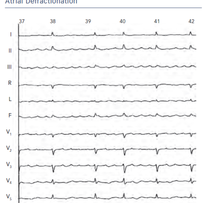 Figure 4 A 12-lead Electrocardiography Showing AtrialTachycardia After Pulmonary Vein Isolation and LeftAtrial Defractionation