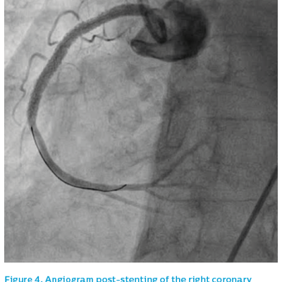 Figure 4. Angiogram post-stenting of the right coronary artery