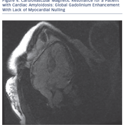 Cardiovascular Magnetic Resonance for a Patient with Cardiac Amyloidosis Global Gadolinium Enhancement With Lack of Myocardial Nulling