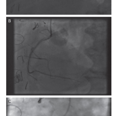 Figure 4 Case Example of a Chronic Total Occlusion of Right Coronary Artery Involving a Previous Stent Recanalised by Antegrade Approach Treated with a Single Drug-coated Balloon and Follow-up Angiographic Appearance at 4 Months
