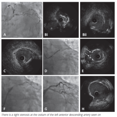 Figure 4 Case example of Proximal Optimisation Technique during provisional stenting in a 67-year-old patient admitted to hospital with an acute coronary syndrome