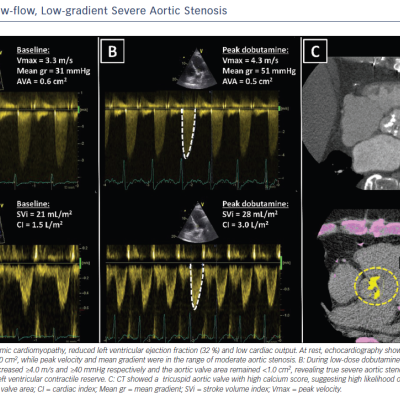 Figure 4 Classical Low-flow Low-gradient Severe Aortic Stenosis
