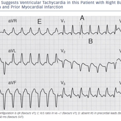 Figure 4 Criteria Incorrectly Suggests Ventricular Tachycardia in this Patient with Right Bundle Branch Block Supraventricular Tachycardia and Prior Myocardial Infarction