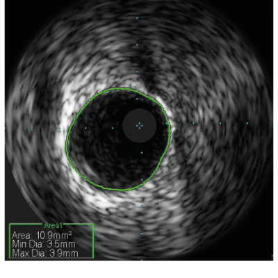 Figure 4. Distal obtuse marginal reference segment