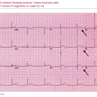 ECG of Black Athlete Showing Anterior T-wave Inversion