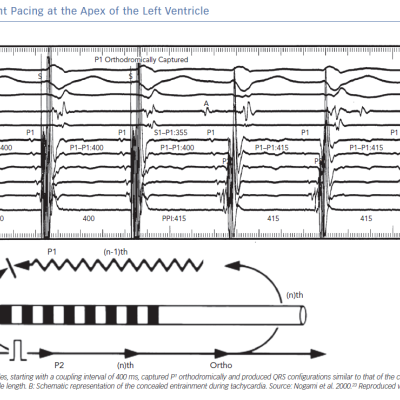 Entrainment Pacing at the Apex of the Left Ventricle