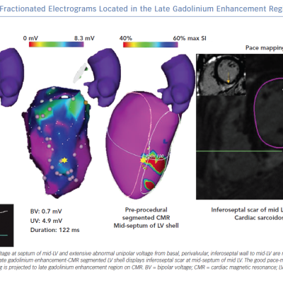 Example of Fractionated Electrograms Located