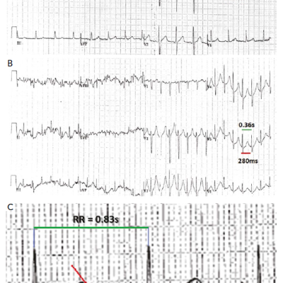Figure 4 Exercise Stress Test ECG in Long-QT Syndrome