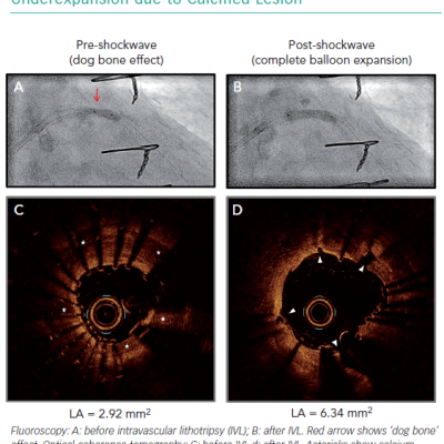 Intravascular Lithotripsy Therapy Effect on Stent Underexpansion due to Calcified Lesion