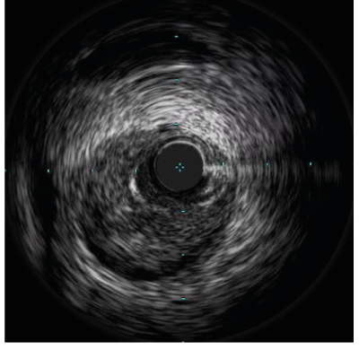 Figure 4. IVUS run of the left anterior descending artery