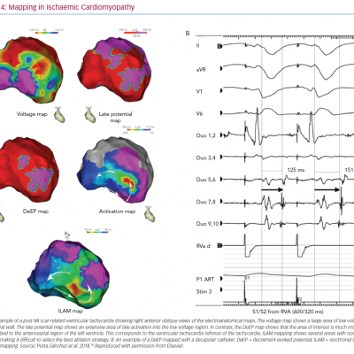 Mapping in Ischaemic Cardiomyopathy