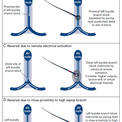 Figure 4 Mechanisms for Left Bundle Branch Block Reversal with His Bundle Pacing