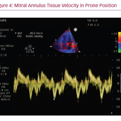 Mitral Annulus Tissue Velocity in Prone Position