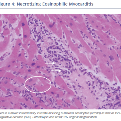 Figure 4 Necrotizing Eosinophilic Myocarditis