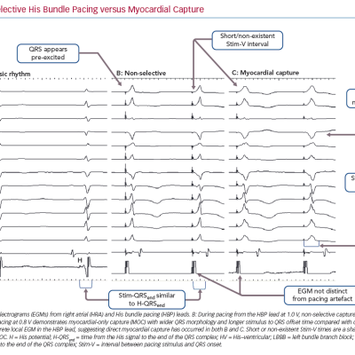 Non-selective His Bundle Pacing versus Myocardial Capture