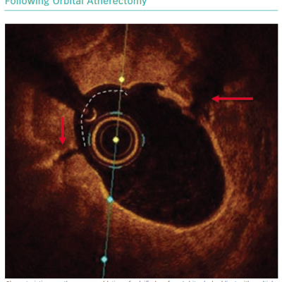 Optical Coherence Tomography Cross-section Following Orbital Atherectomy