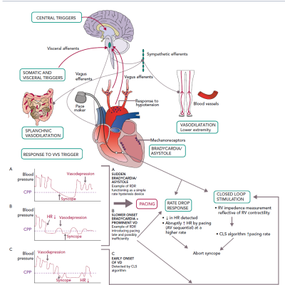 Figure 4 Pathophysiological Mechanisms in VVS Leading to Bradycardia and Hypotension Role of Pacing and Currently Used Pacing Algorithms