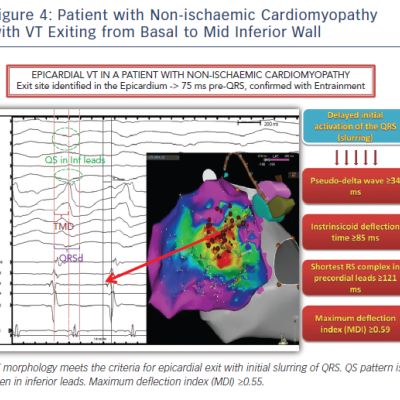 Patient with Non-ischaemic Cardiomyopathy