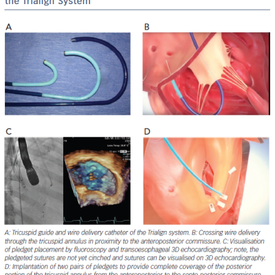 Figure 4 Percutaneous Tricuspid Valve Annuloplasty Using the Trialign System