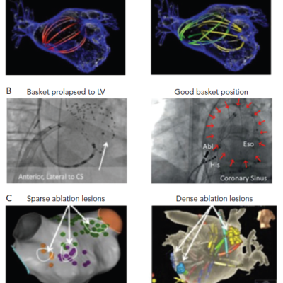 Reported Pearls &ampamp Pitfalls in AF Source Ablation