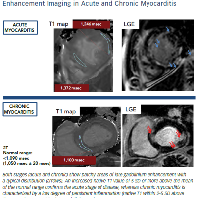 Figure 4 Representative T1 And Late Gadolinium Enhancement Imaging In Acute And Chronic Myocarditis