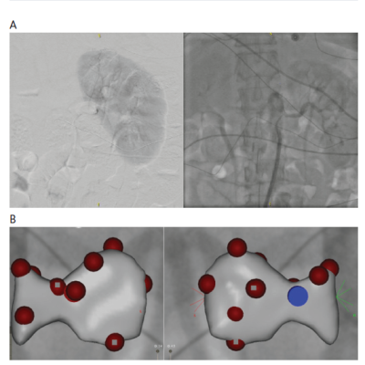 Role of Electrophysiolgical Mapping During Renal Denervation