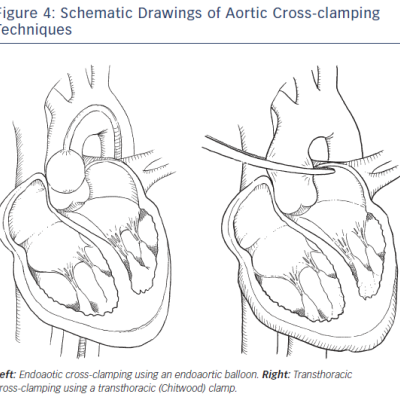 Figure 4 Schematic Drawings of Aortic Cross-clamping Techniques