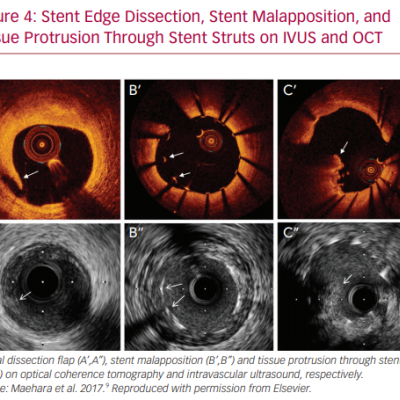 Stent Edge Dissection Stent Malapposition