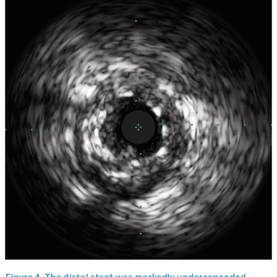 Figure 4. The distal stent was markedly underexpanded