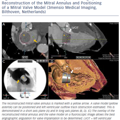 Figure 4 Three-dimensional Computed Tomographic Reconstruction of the Mitral Annulus and Positioning&ampltbr /&ampgt&amp10of a Mitral Valve Model