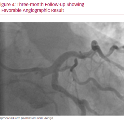 Three-month Follow-up Showing a Favorable Angiographic Result