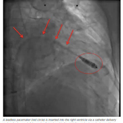 Transcatheter Delivery of a Leadless Pacemaker