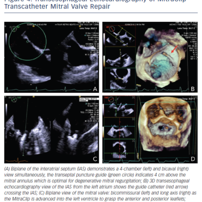 Figure 4 Transesophageal Echocardiography of MitraClip Transcatheter Mitral Valve Repair