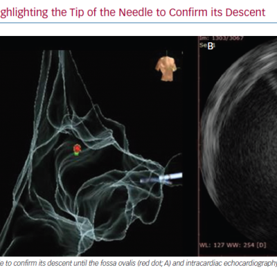 Transseptal Puncture Highlighting the Tip