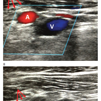 Ultrasound Imaging of the Axillary Artery