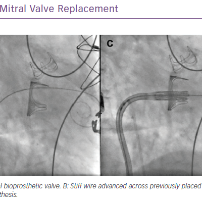 Valve-in-valve Transcatheter Mitral Valve Replacement