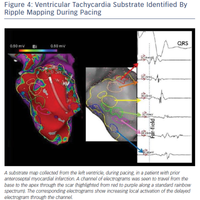 Ventricular Tachycardia Substrate Identified By Ripple Mapping During Pacing